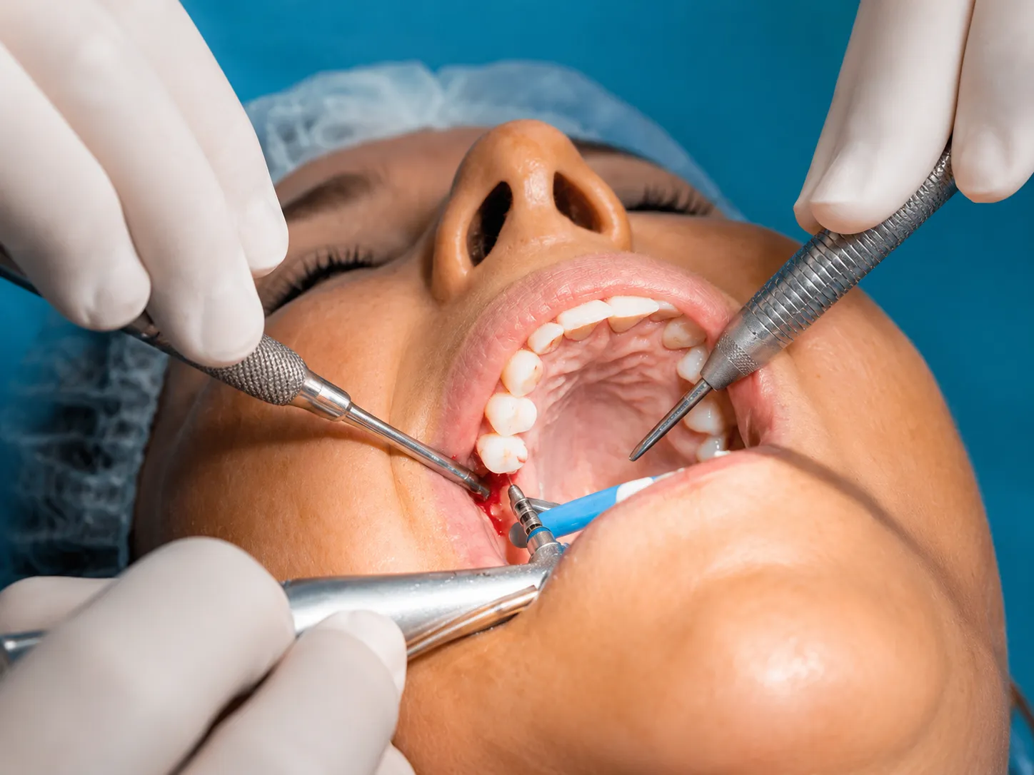 Endodoncia en Neodentis