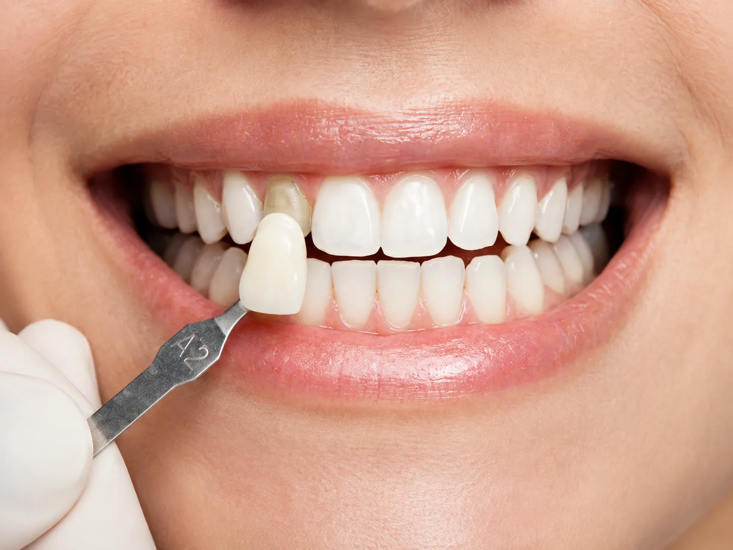 Estética dental en Neodentis