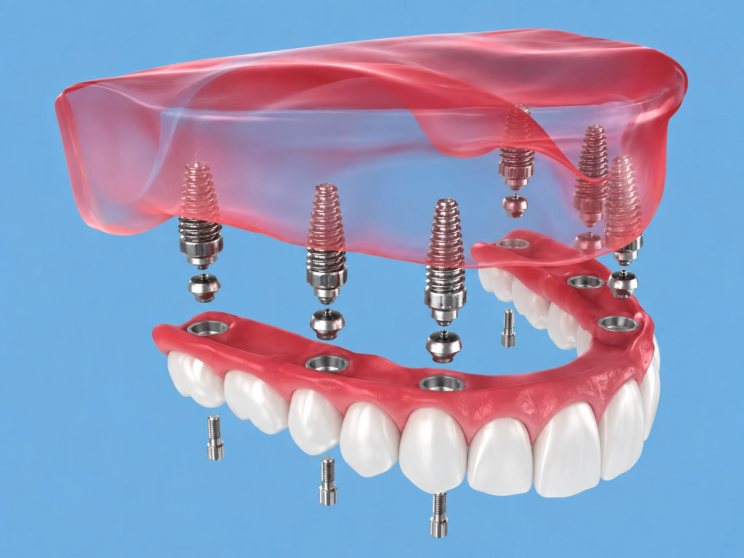 Rehabilitación de arcada completa sobre implantes