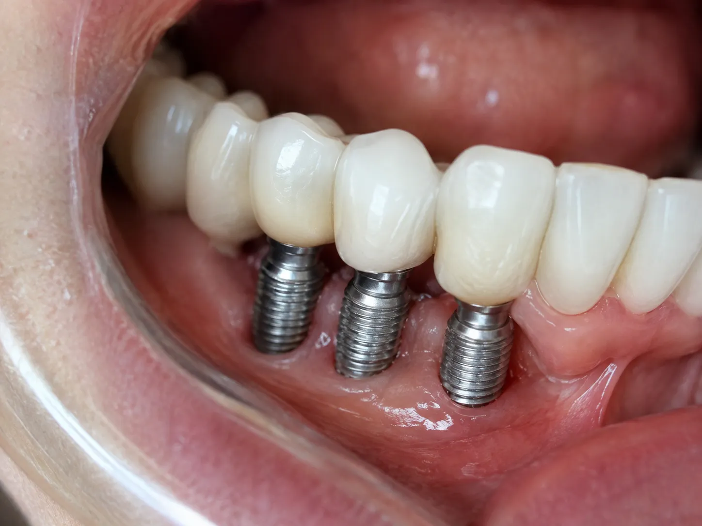 Implantes dentales en Neodentis