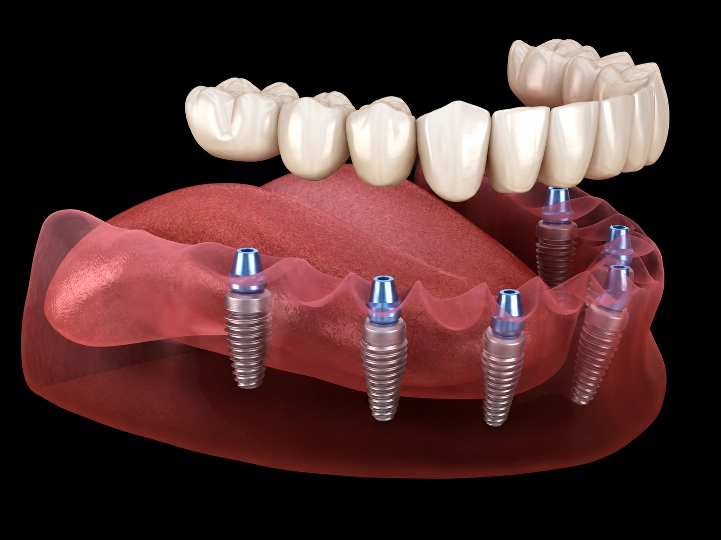 Puente fijo sobre varios implantes