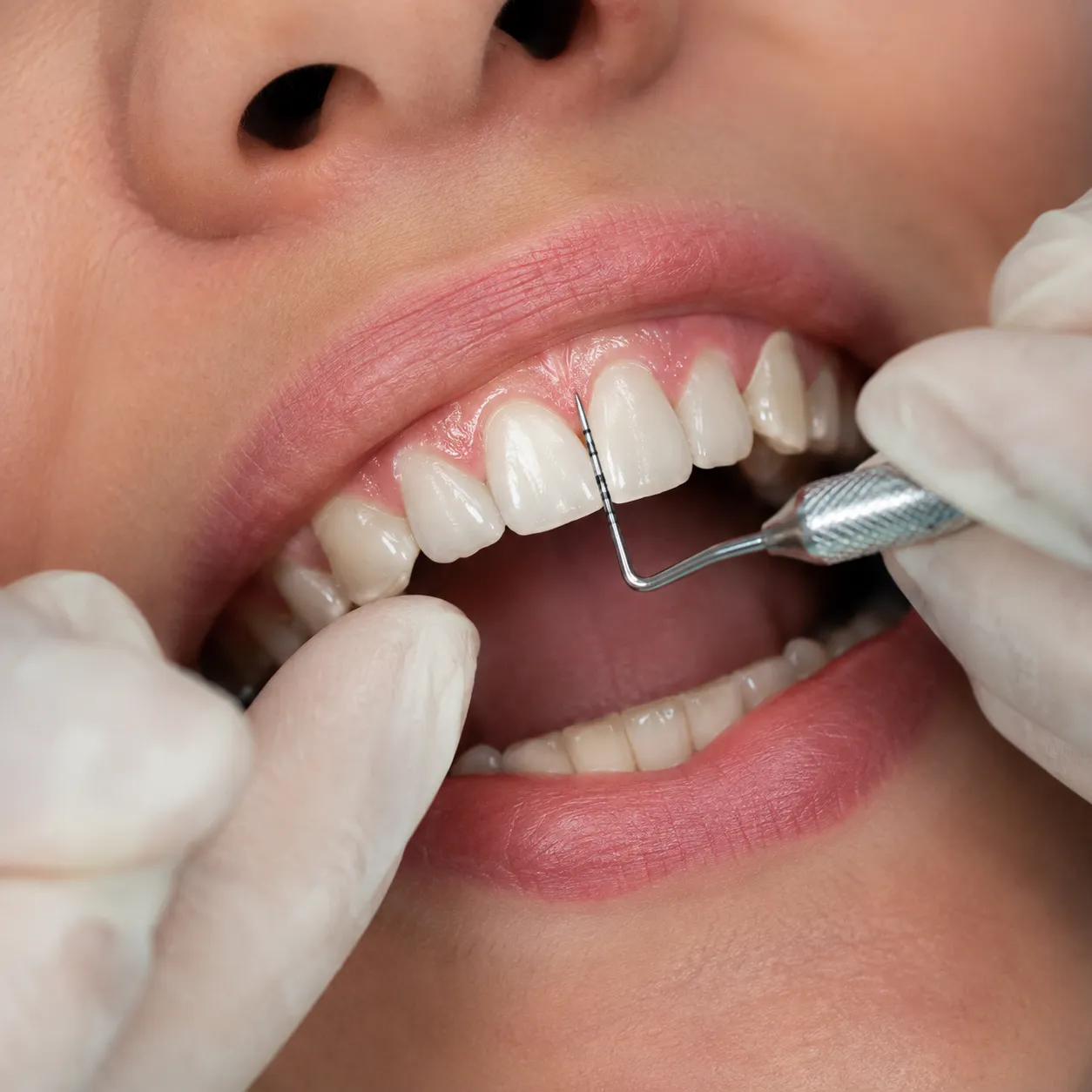 Sondaje periodontal